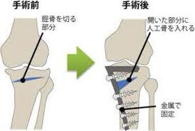 高位脛骨骨切り術という選択 ―ひざを「人工物に置き換える」のではなく「自分の骨を温存する」治療